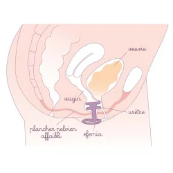 Pessaire fuite urinaire Efemia