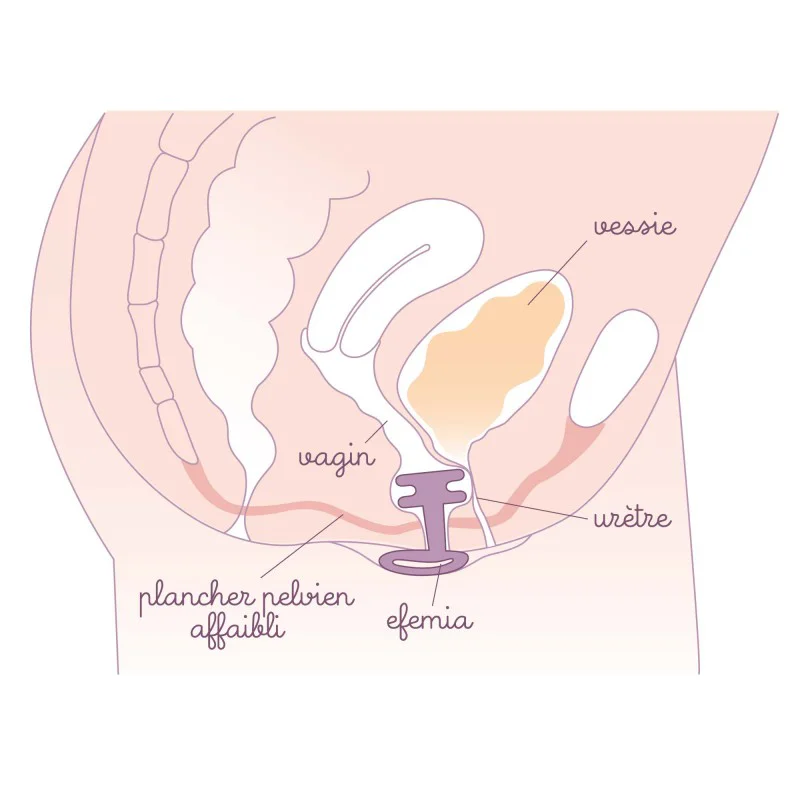 Pessaire fuite urinaire Efemia