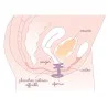 Pessaire fuite urinaire Efemia